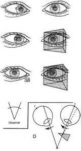 馬篤氏鏡原理|Motor Signs in Heterophoria and Heterotropia